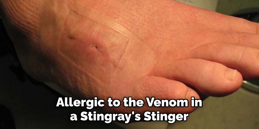 Allergic to the Venom in a Stingray's Stinger